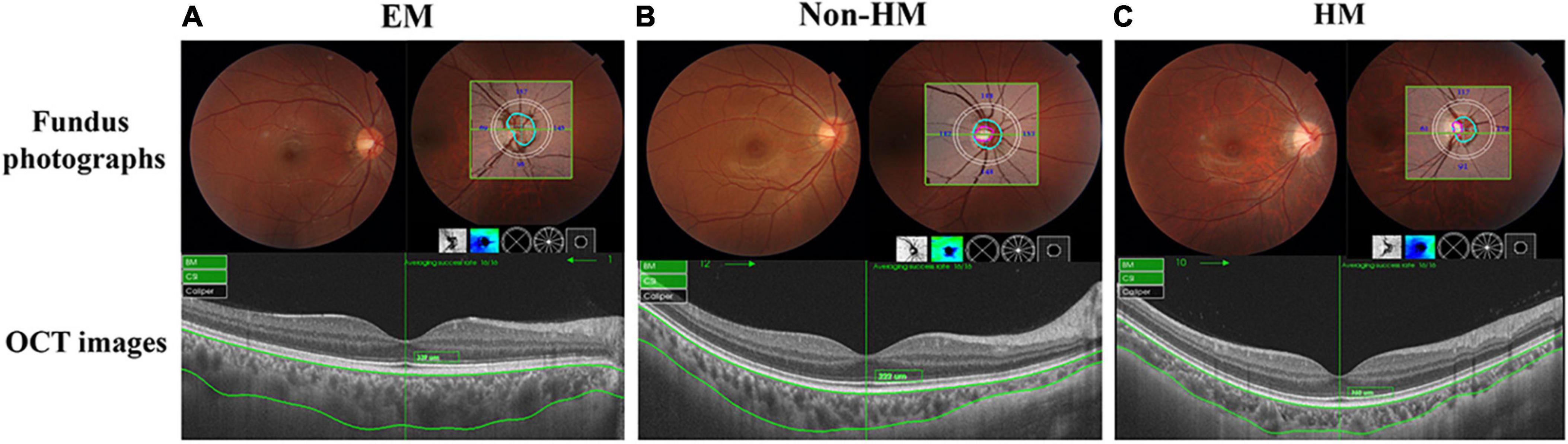 EFEMP1 is a potential biomarker of choroid thickness change in myopia